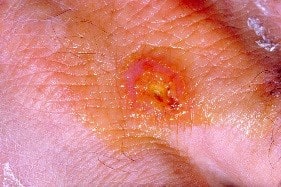 زخم متورم و قرمز رنگ تولارمی بر روی سطح پوست انسان، از بیماری های مشترک انسان و خرگوش